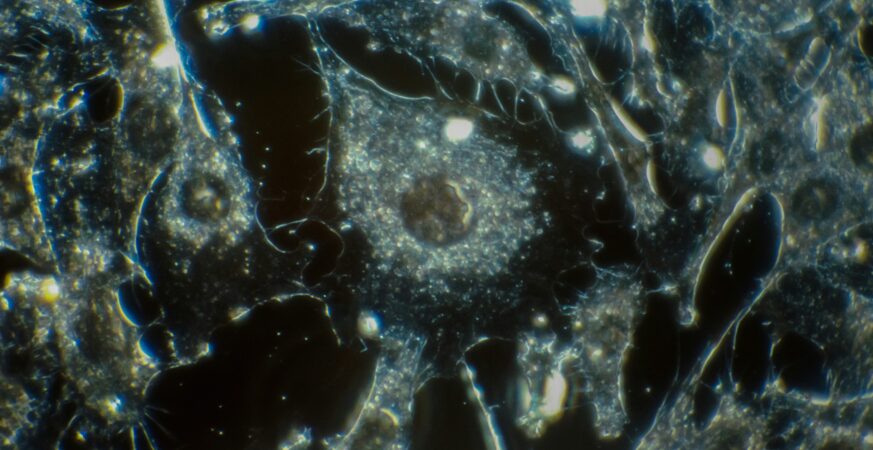 cancer cells